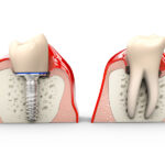 インプラントと天然歯の違いについて